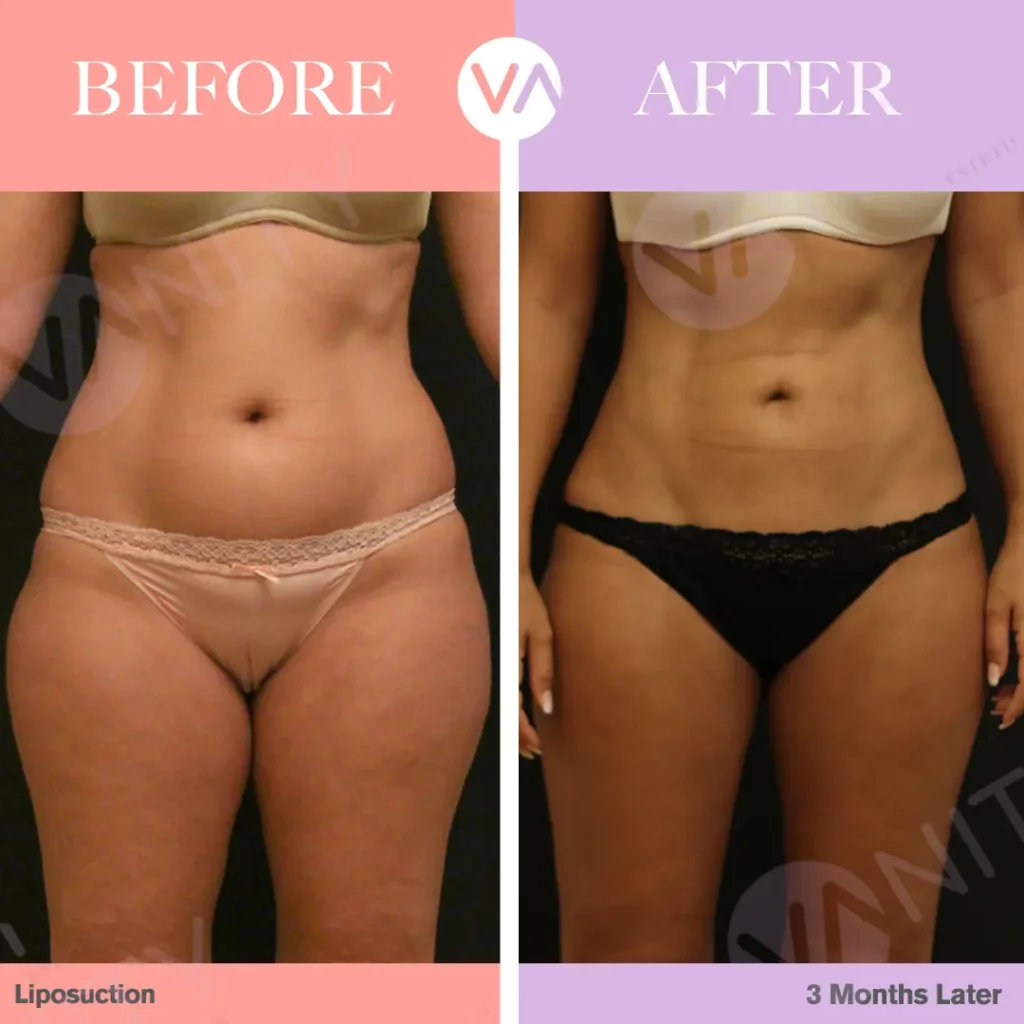 Traditional liposuction vs minimally invasive liposuction - Phoenix  Cosmetic Surgeon, Body by Kotoske