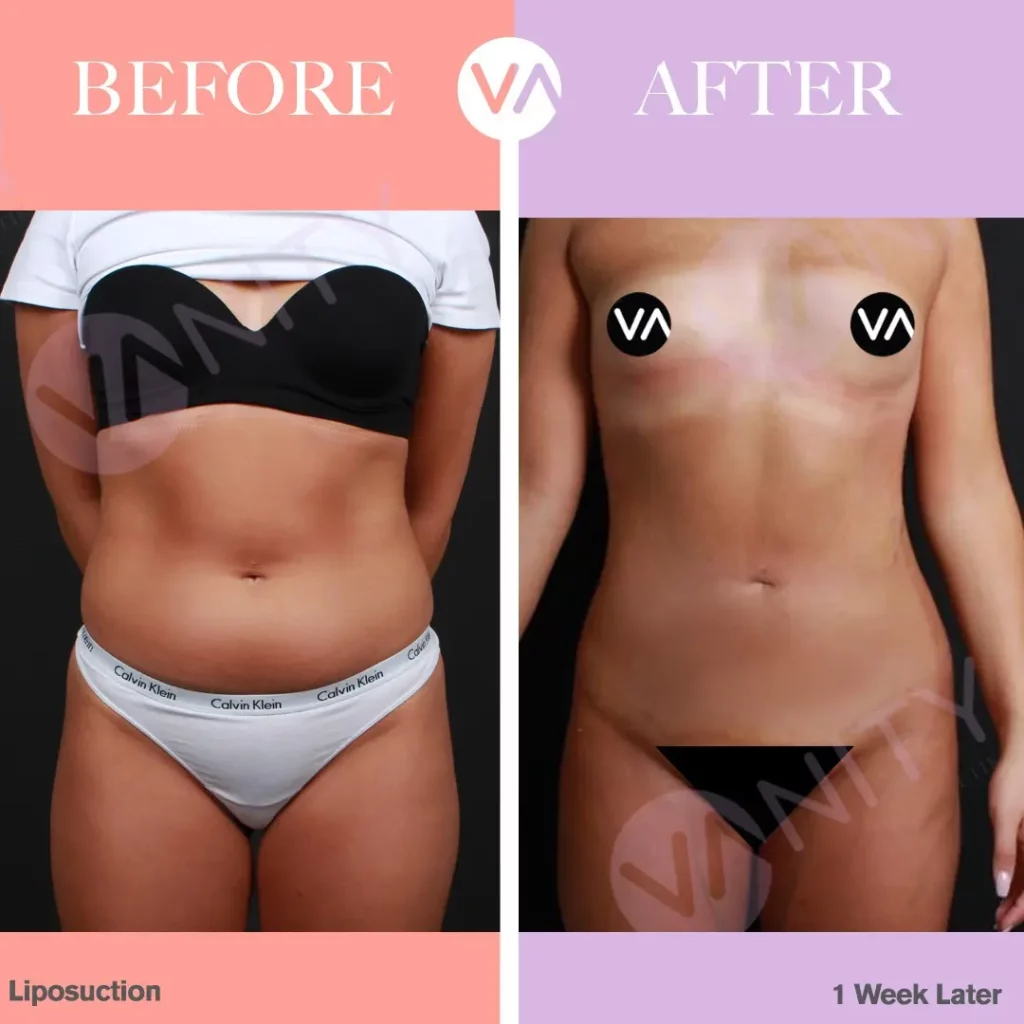 Liposuction in Turkey - All Inclusive Package Cost 2024