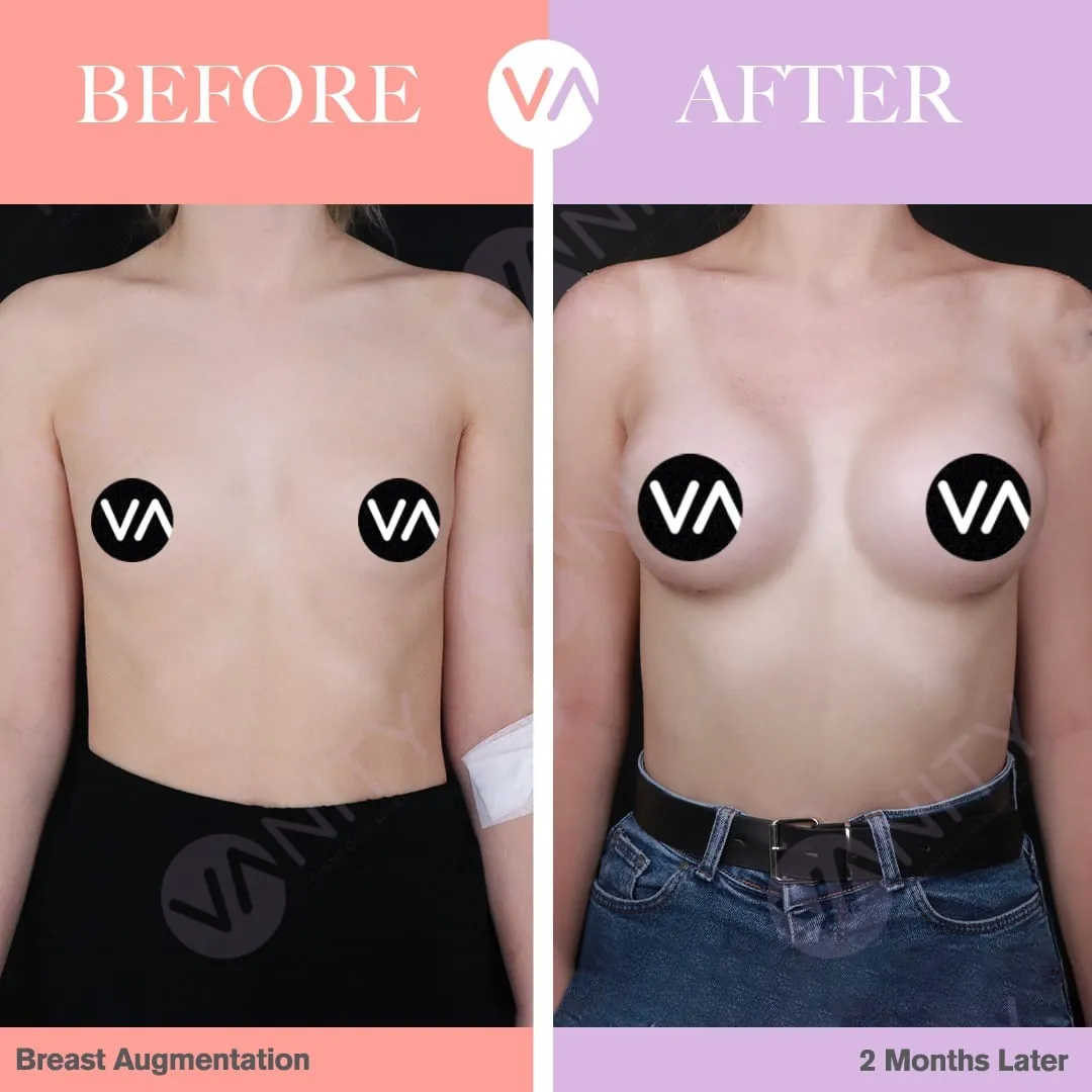 What you can really expect during a breast augmentation recovery