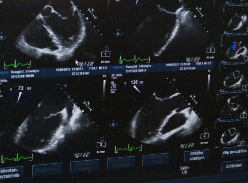 Ultrasound Guided BBL 2