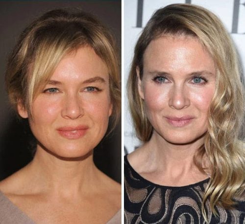 Renée Zellweger Before and After Plastic Surgery