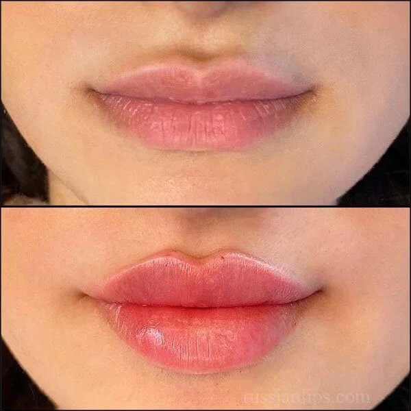 The Most Desired Lip Shapes, According to a Plastic Surgeon