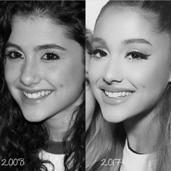 Celebrity plastic surgery procedures - before and after photos - Ariana  Grande, Gallery