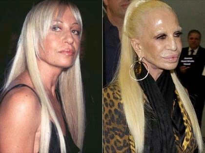 Donatella Versace Before and After Plastic Surgery : r/cringe
